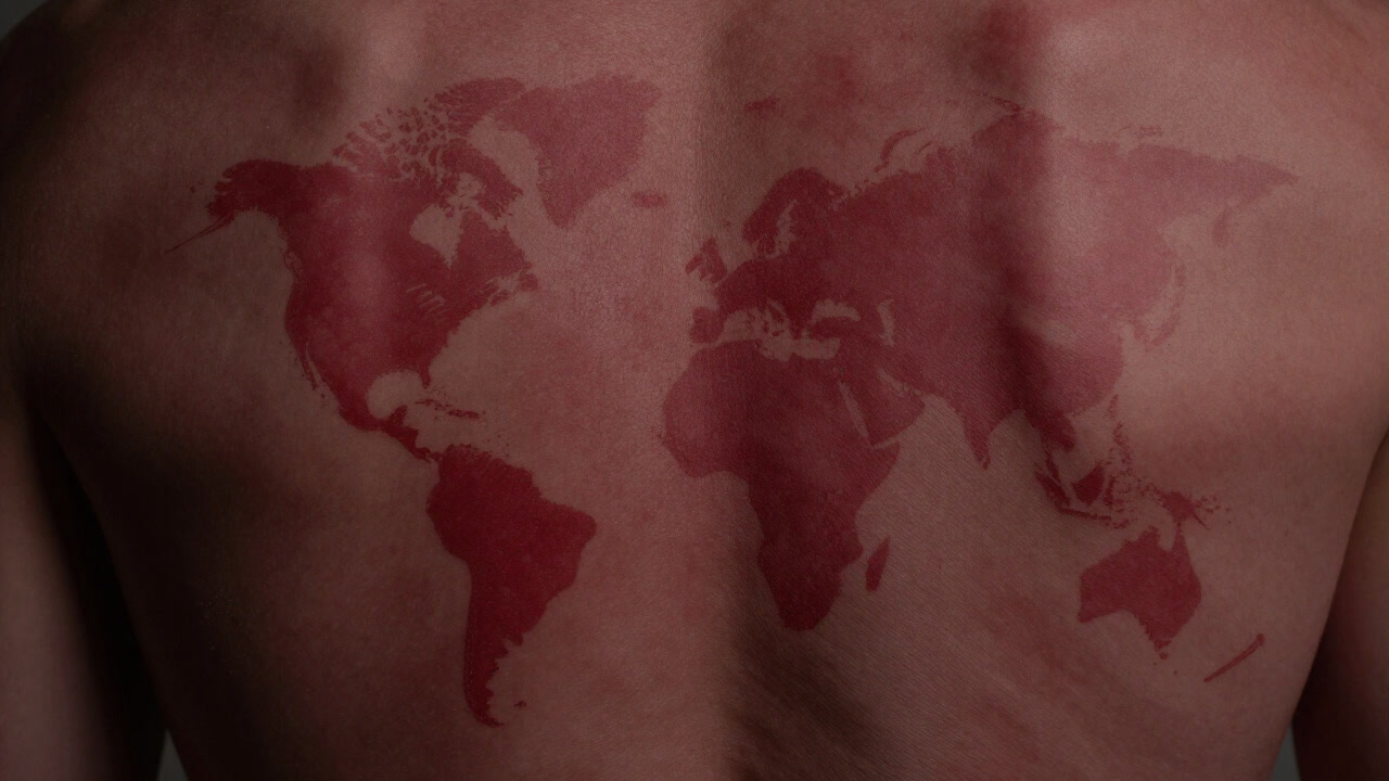 赤い斑点が地図のように散らばる腕のクローズアップ写真